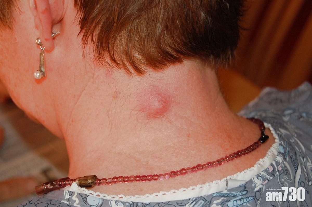 粉瘤｜愈擠隨時愈衰