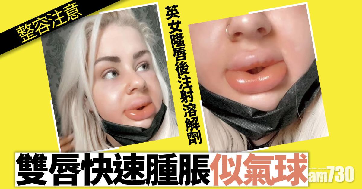 整容注意｜英女隆唇後注射溶解劑  雙唇快速腫脹似氣球