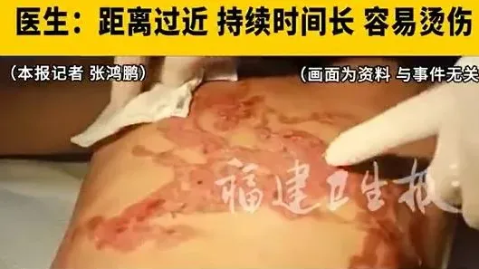 嫲嫲怕5歲孫仔凍親開風筒吹背取暖　吹到全身出黑煙20%燙傷