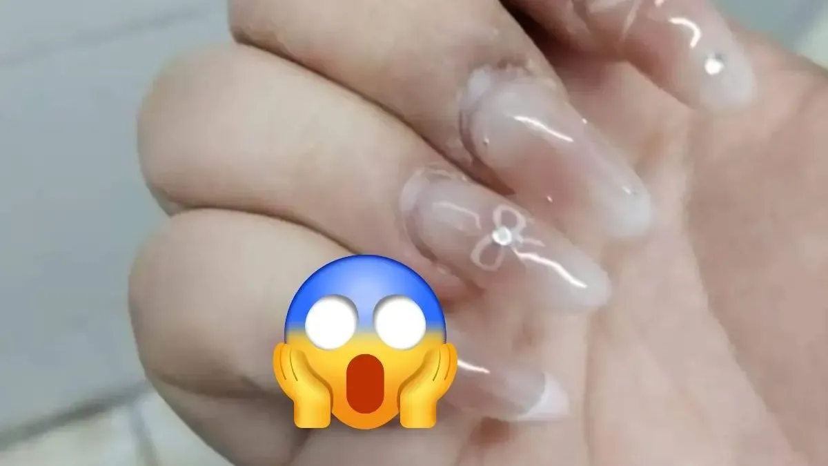 內地女美甲後感染HPV病毒生「椰菜花」疣　醫生：打磨指甲會破壞保護膜