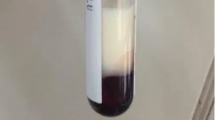 浙江嬰兒狂咳送院檢查時抽出「牛奶血」　醫生：患高血脂症極危險