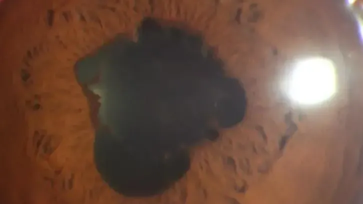 內地男過年捱夜狂追劇　瞳孔竟發炎成「花瓣狀」