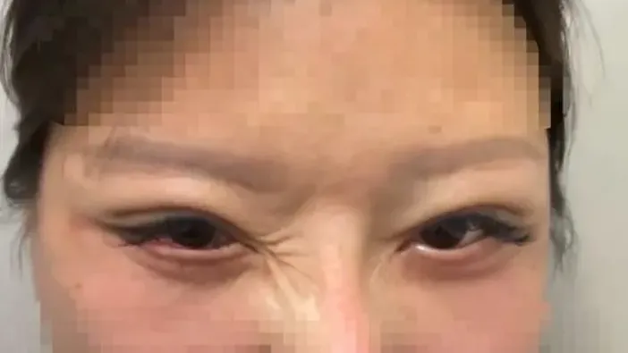 內地女開雙眼皮後眼睛竟閉不起來　控訴黑心診所