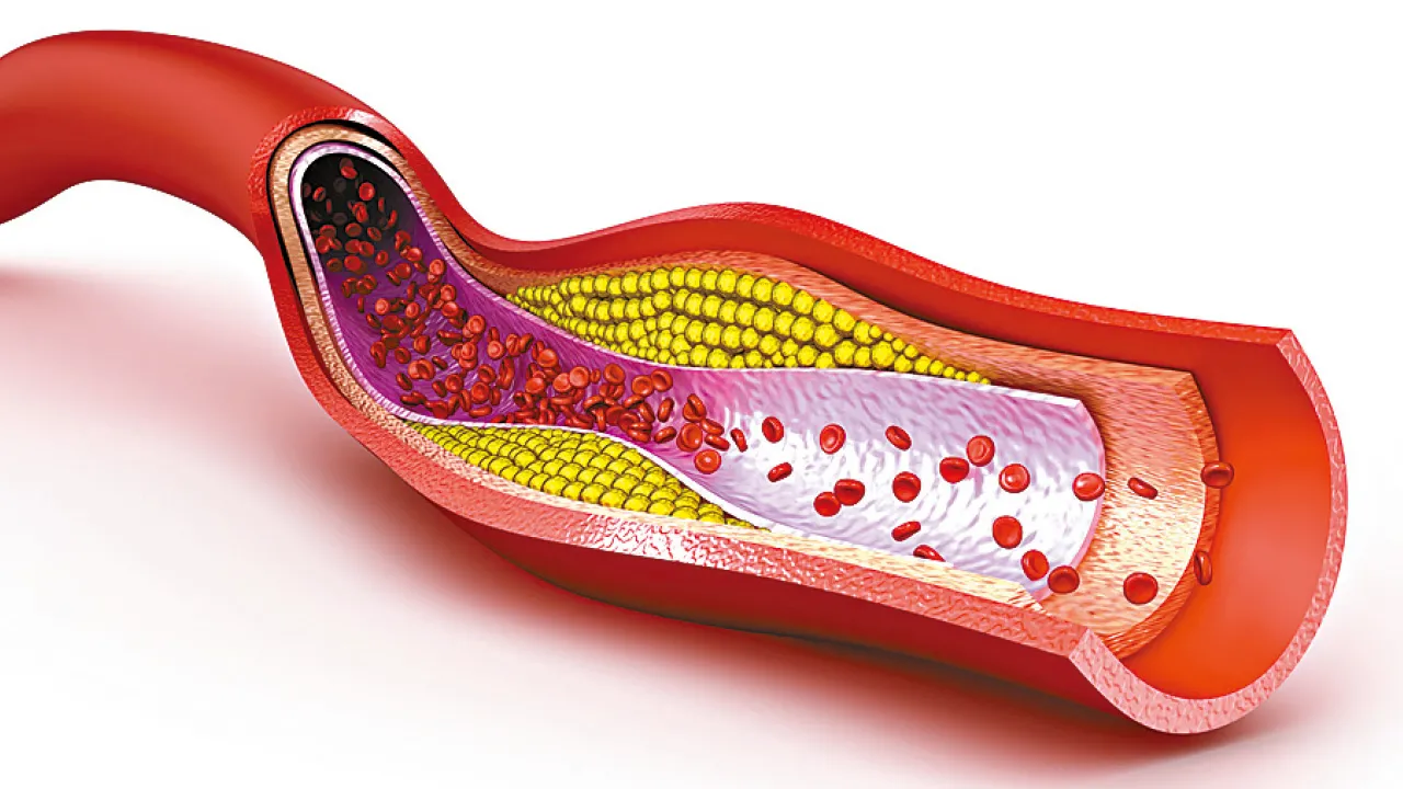 高膽固醇的危害與管理