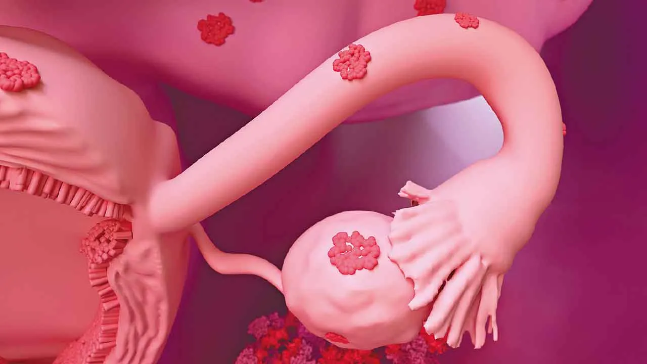 舊藥新用 治療子宮內膜異位症