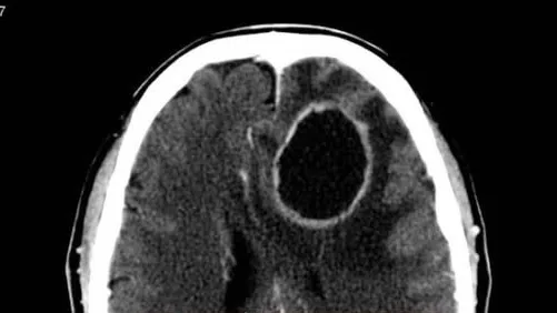 醫生公布老婦的檢查影像，顯示她患上腦部膿瘍。(互聯網)