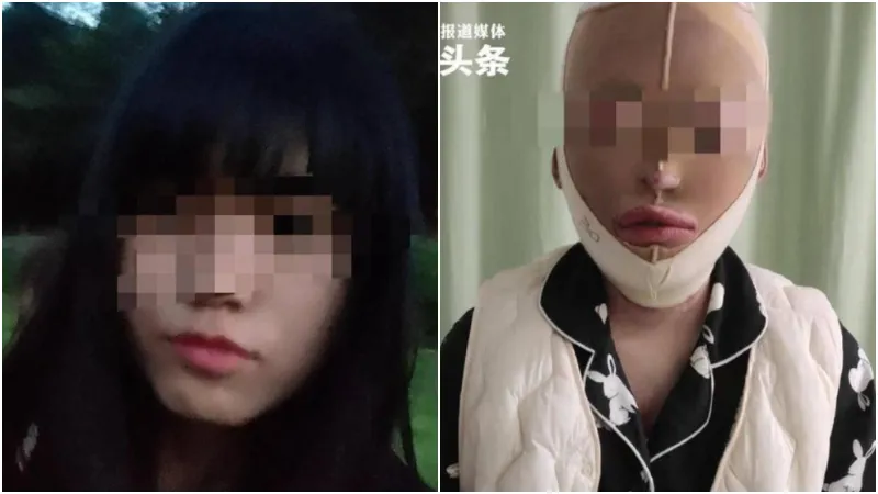 湖北男分手後淋汽油報復　前女友全身7成燒傷截肢毀容