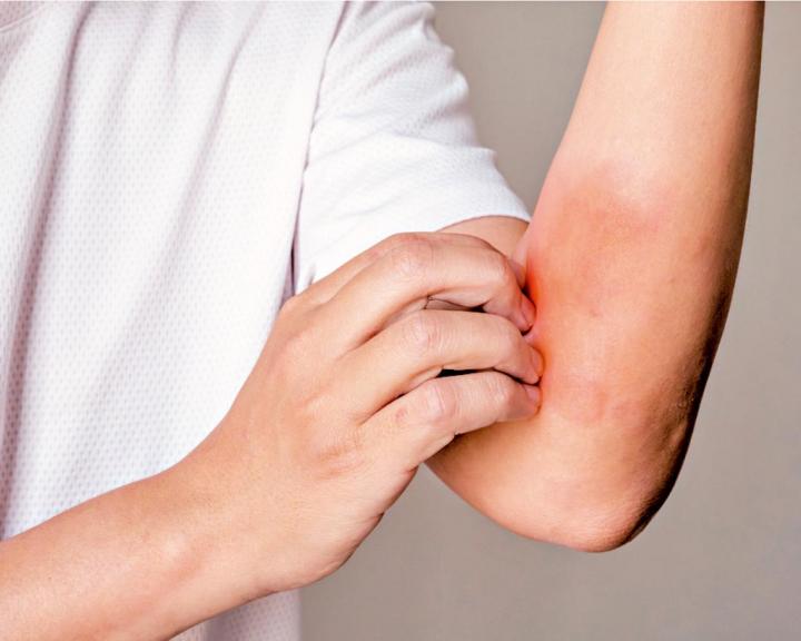 飲食與濕疹：從營養角度改善濕疹