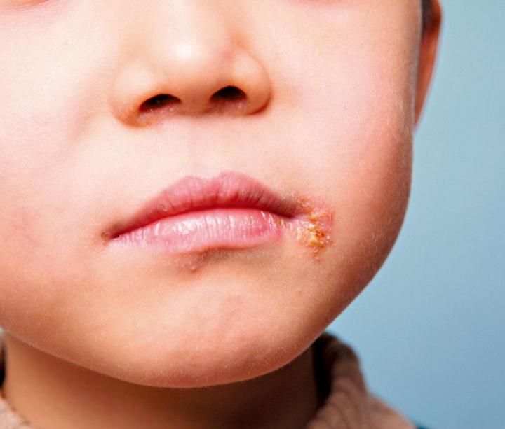 了解疱疹病毒在兒童中的感染(一)