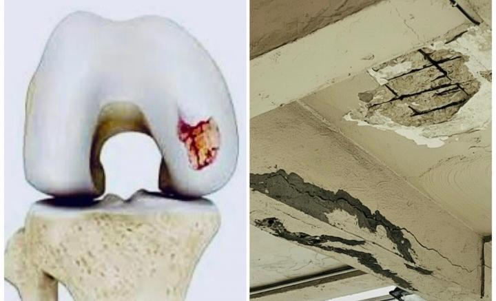 膝關節大維修事件簿